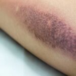 Burn Injury Burn Injury
